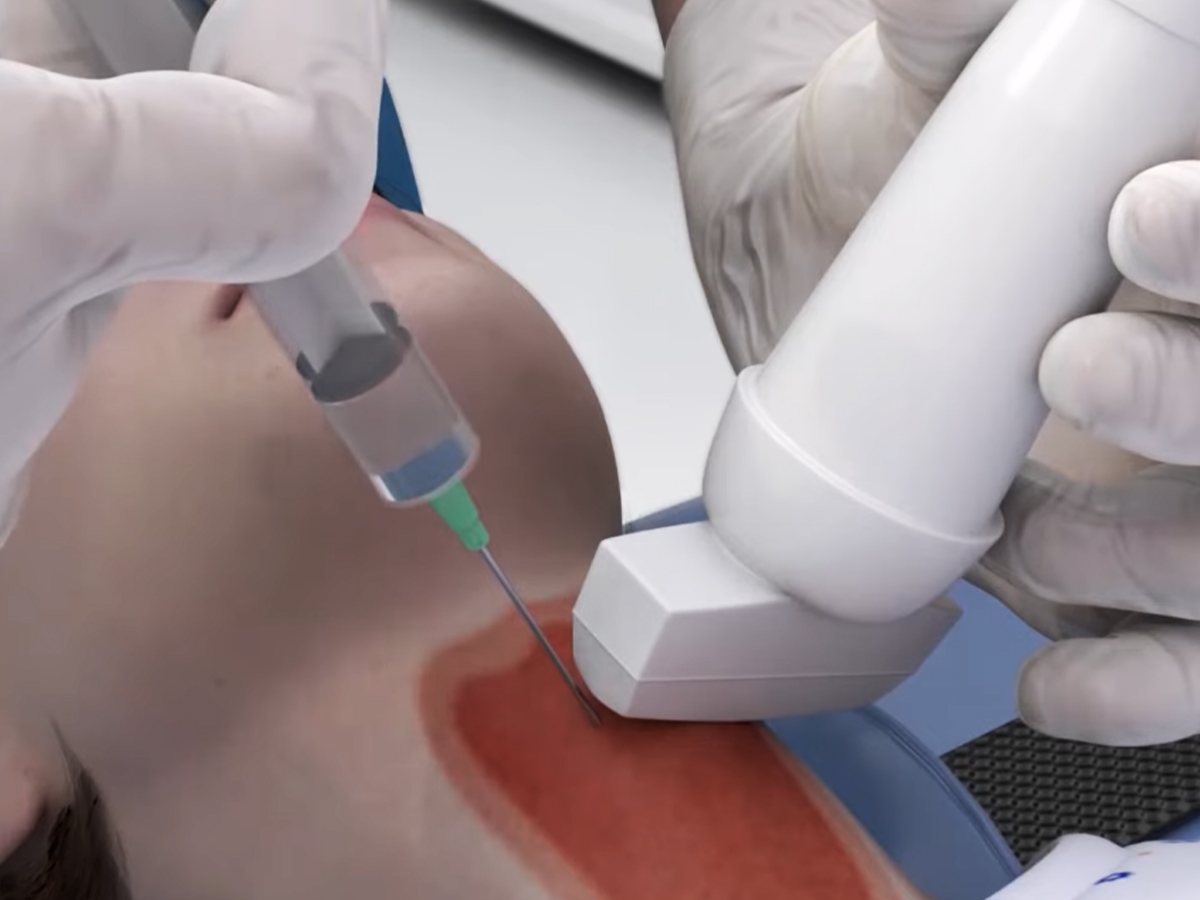 Grafik: Injektion des Betäubungsmittels Grafik: Injektion des Betäubungsmittels