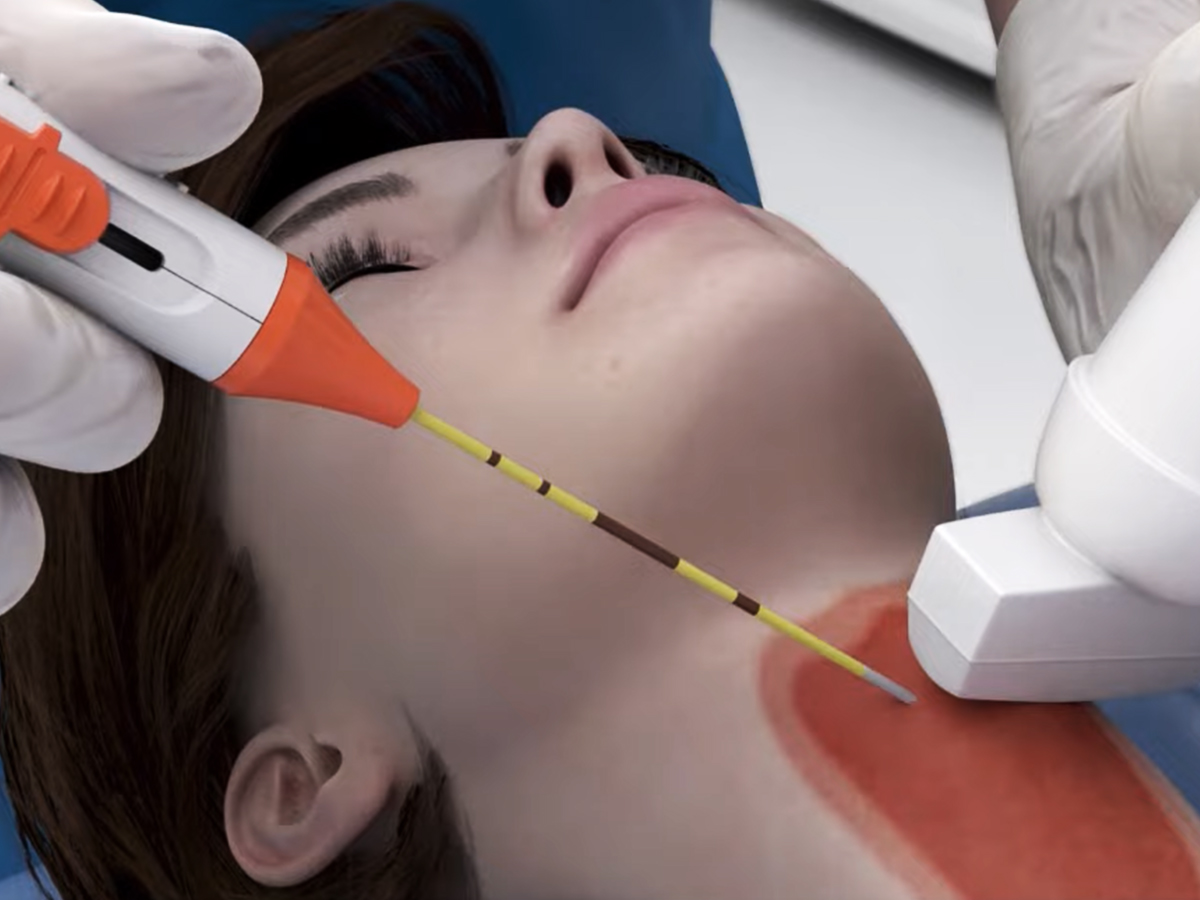 Grafik: Einführung der Elektrode Grafik: Einführung der Elektrode