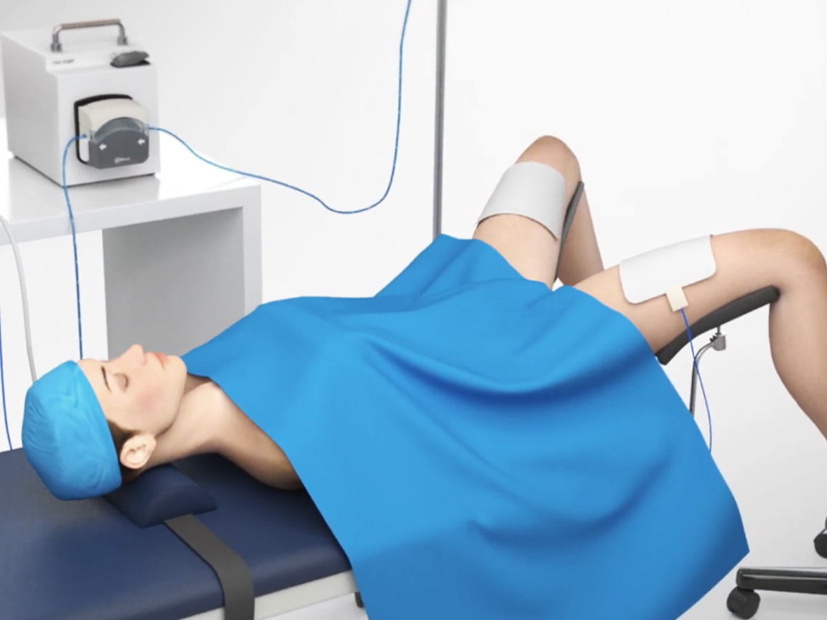 Grafik: Patientin in Steinschnittlage Grafik: Patientin in Steinschnittlage