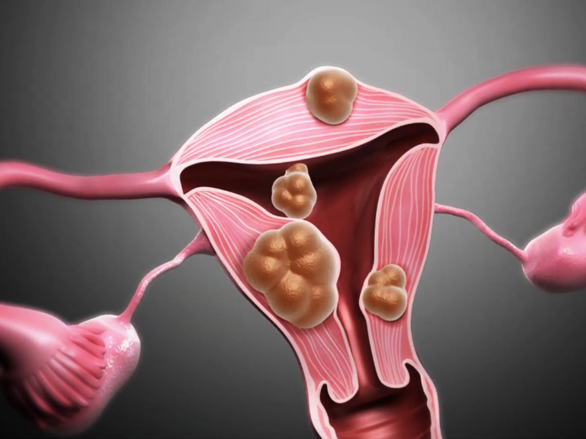 Illustration: Uterusmyome Illustration: Uterusmyome