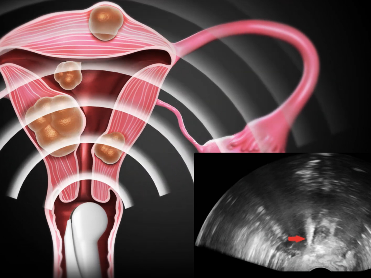 Illustration: Platzierung der Elektrode Illustration: Platzierung der Elektrode