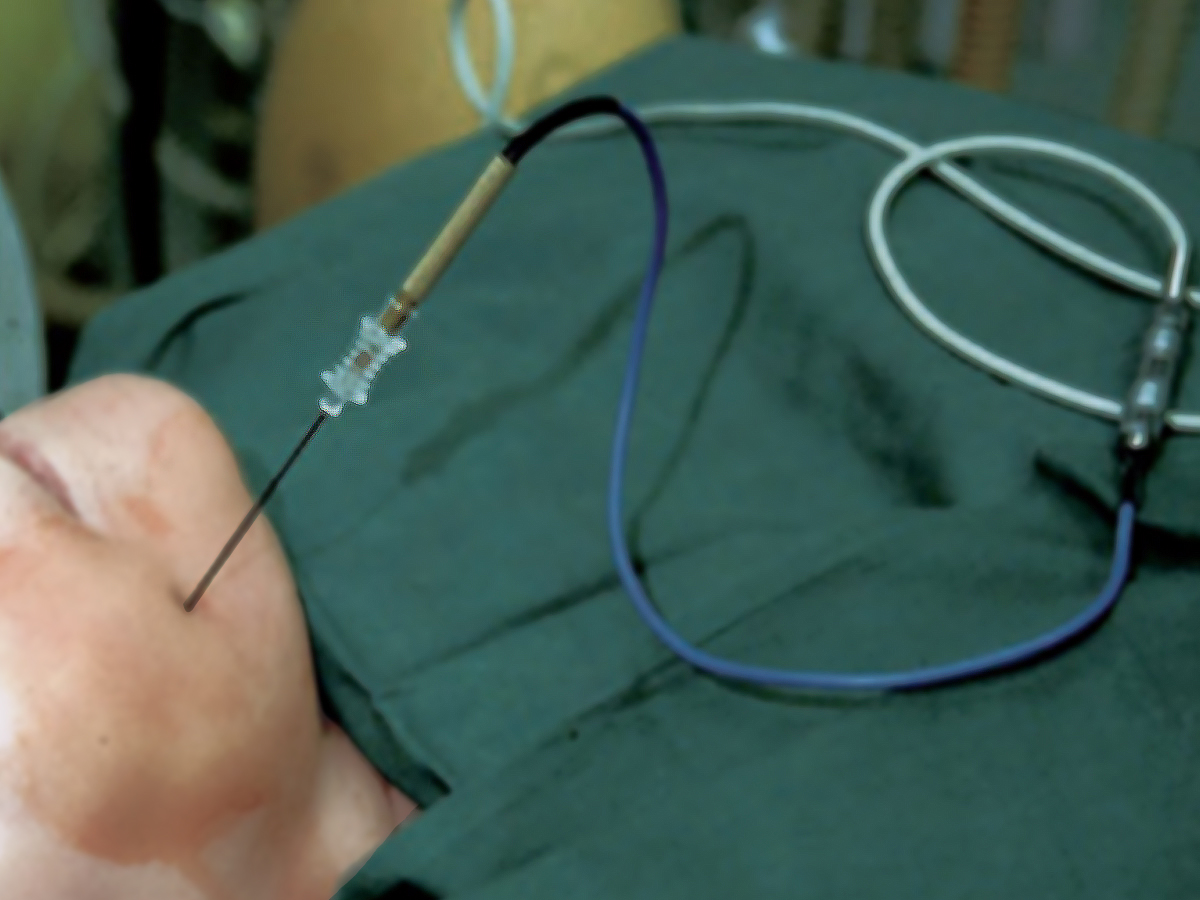 Foto: Position der Radiofrequenzkanüle während des Eingriffs Foto: Position der Radiofrequenzkanüle während des Eingriffs