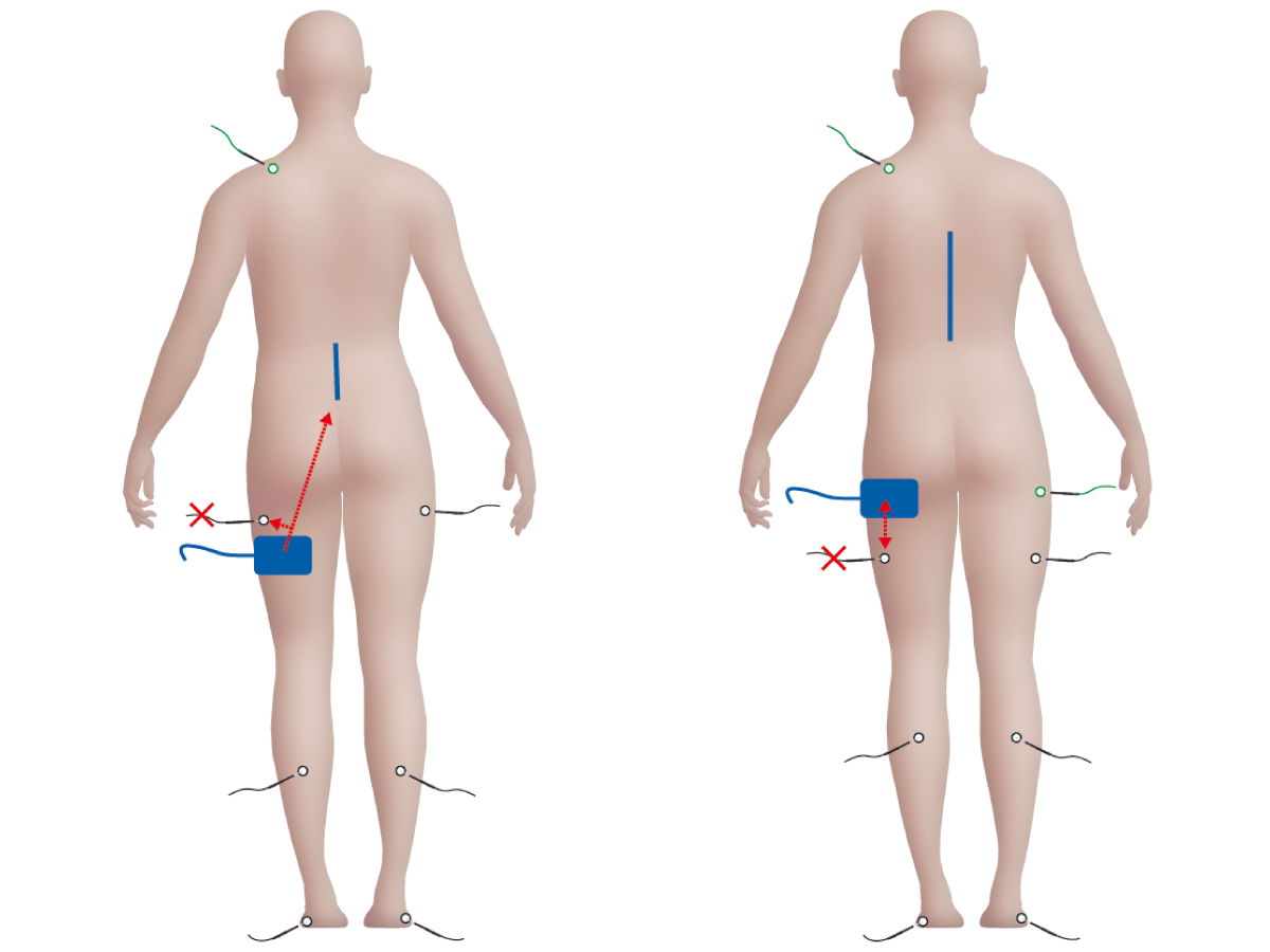 Illustration: Anatomische Position der Elektroden Illustration: Anatomische Position der Elektroden
