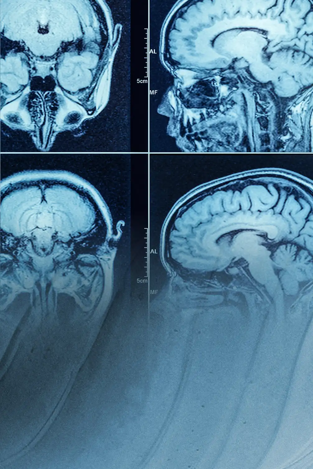 Elektrischer Promontorialtest zur Indikation von verschiedenen Hörerkrankungen