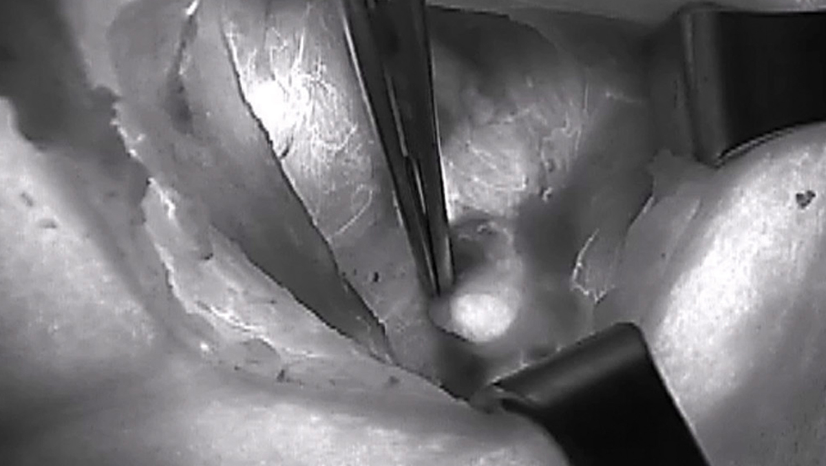 Autofluoreszenz der Nebenschilddrüsen